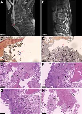 Intervertebral disc cell chondroptosis elicits neutrophil response in Staphylococcus aureus spondylodiscitis